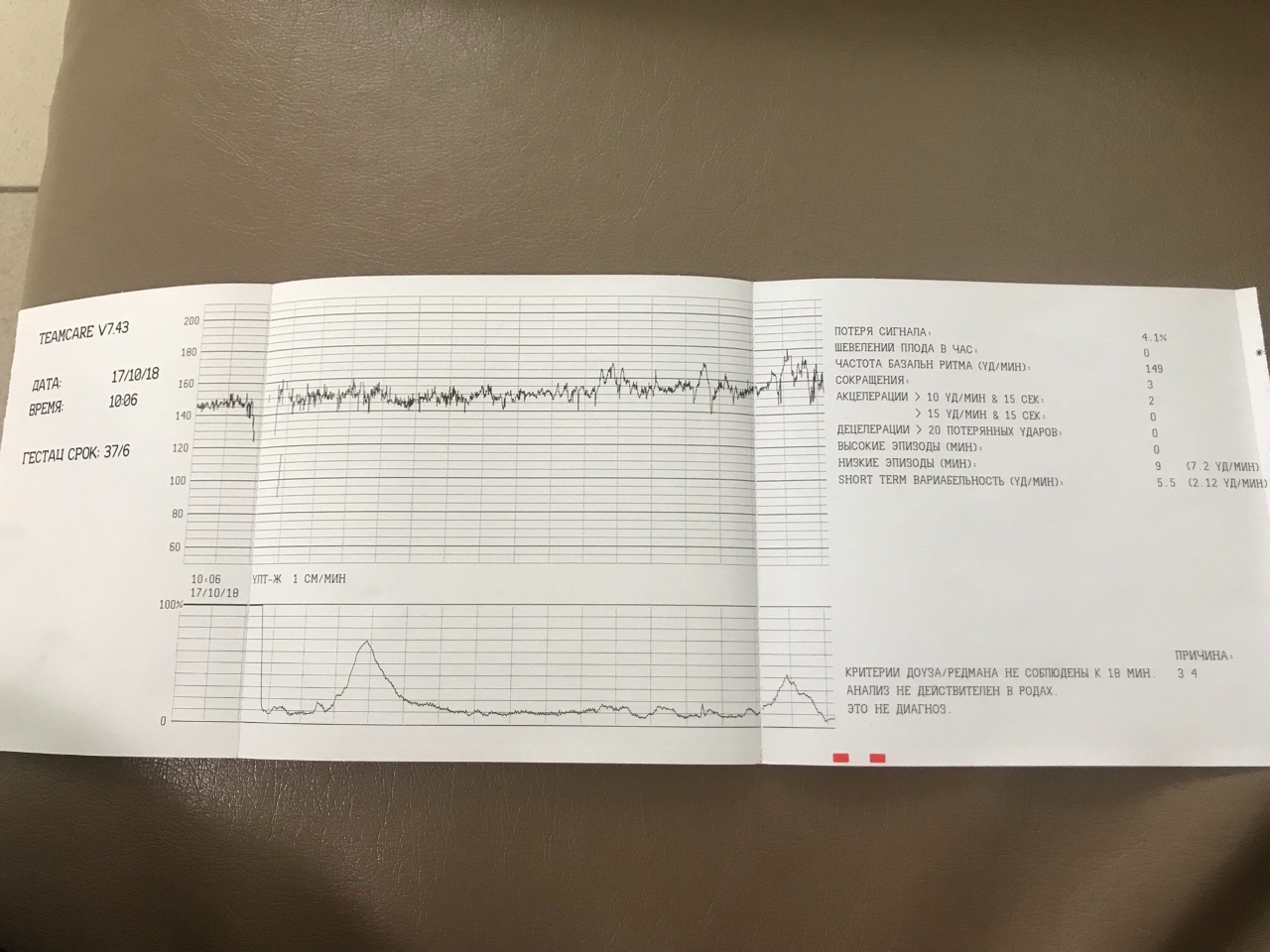 Ли ктг. Шевеления на КТГ. Кабинет КТГ В женской консультации. Помогите расшифровать КТГ. Акцелерации на КТГ.