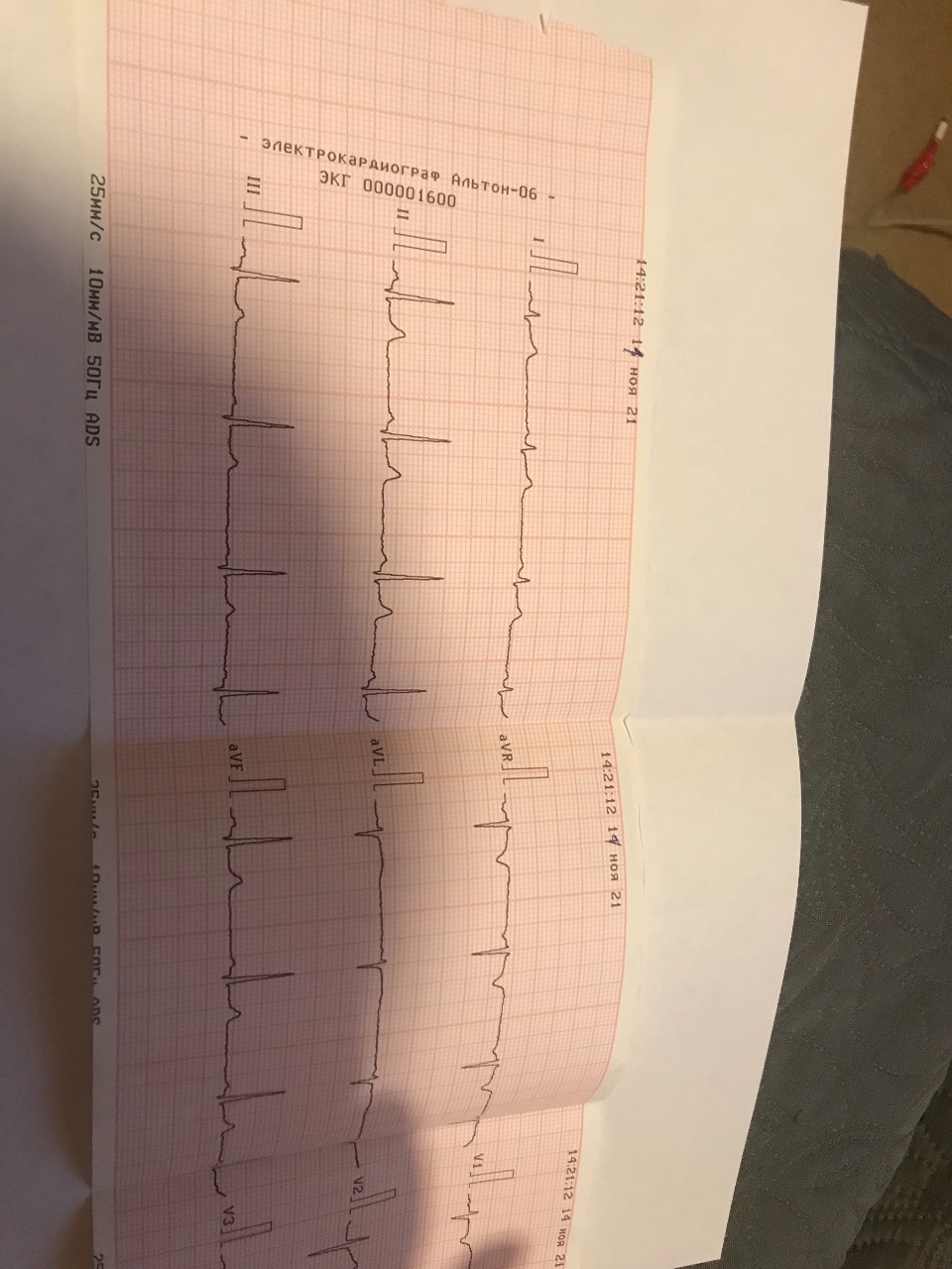 Расшифровка кардиограммы по фото