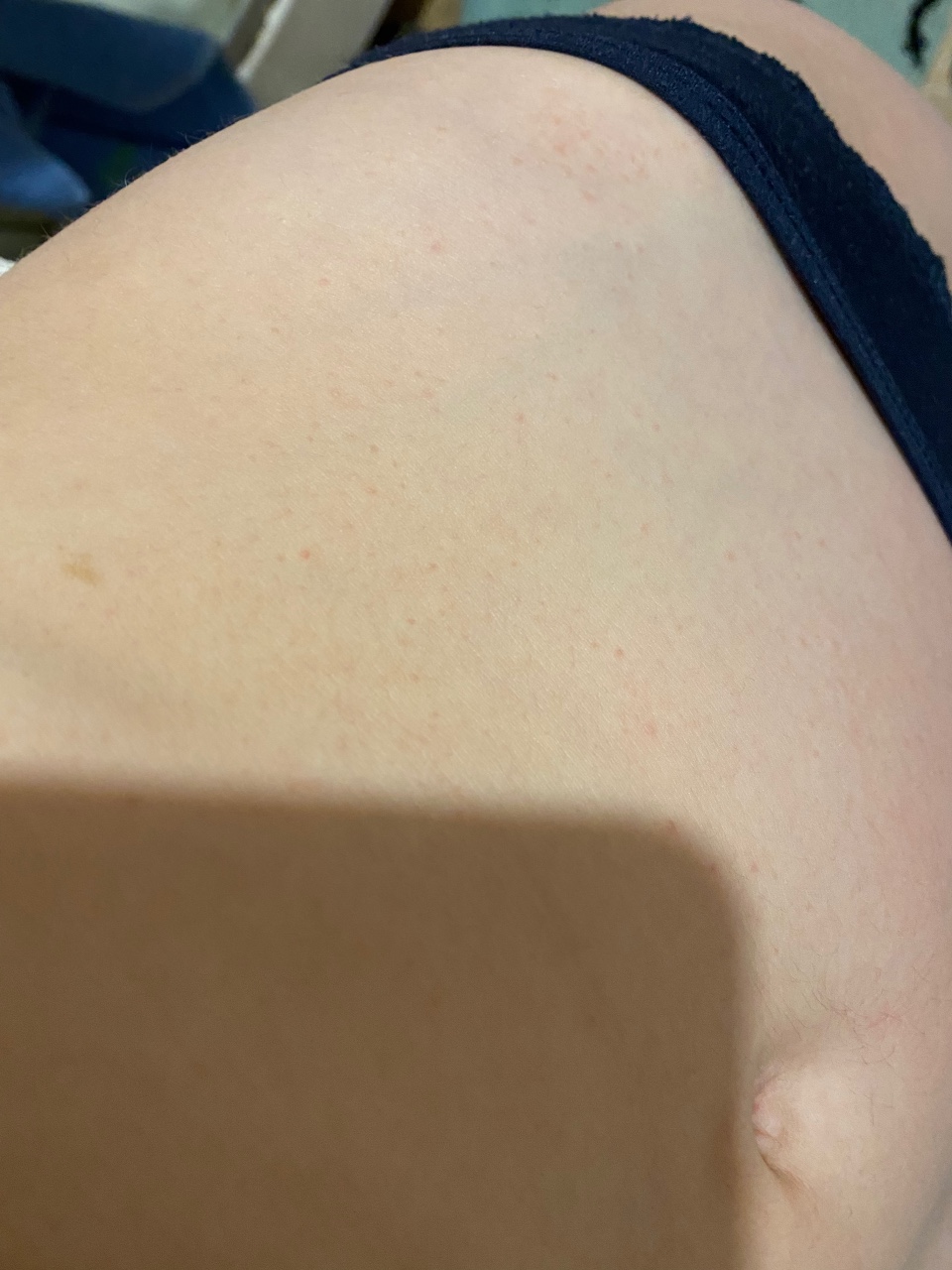 прыщи на груди и спине во время беременности фото 112