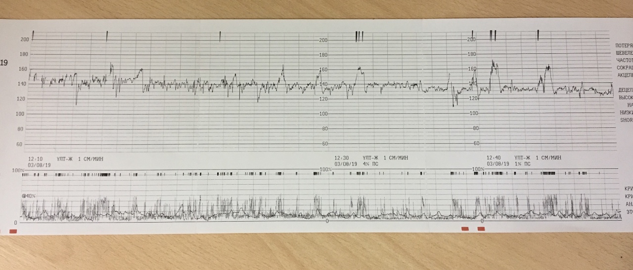 Ктг при беременности баллы