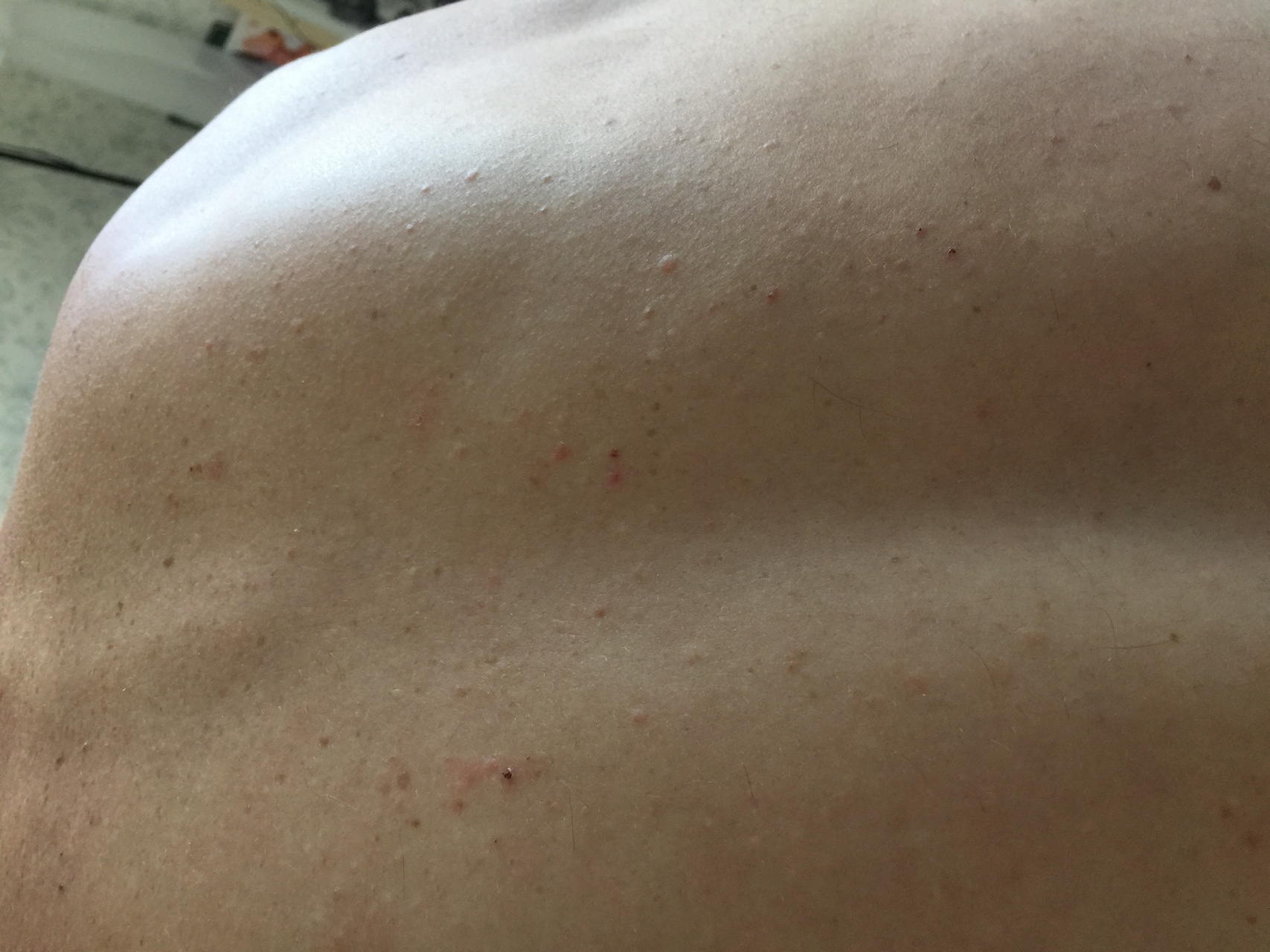 сыпь на спине и груди у женщин фото 5