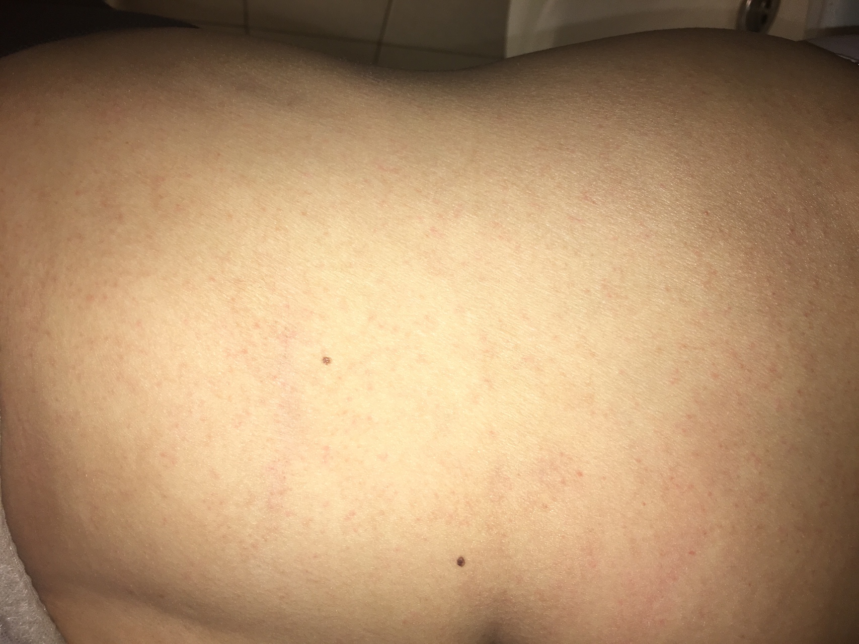 красная сыпь на груди во время беременности фото 68