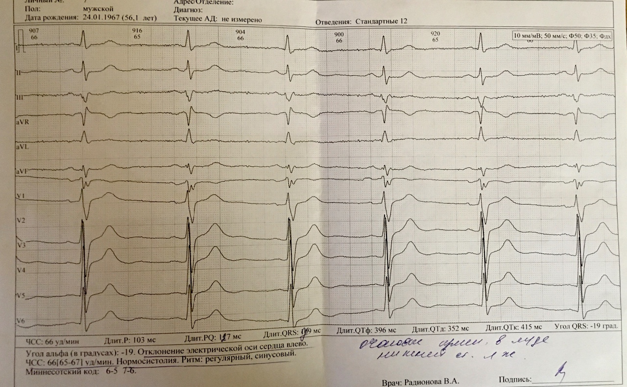 Расшифровка кардиограммы по фото