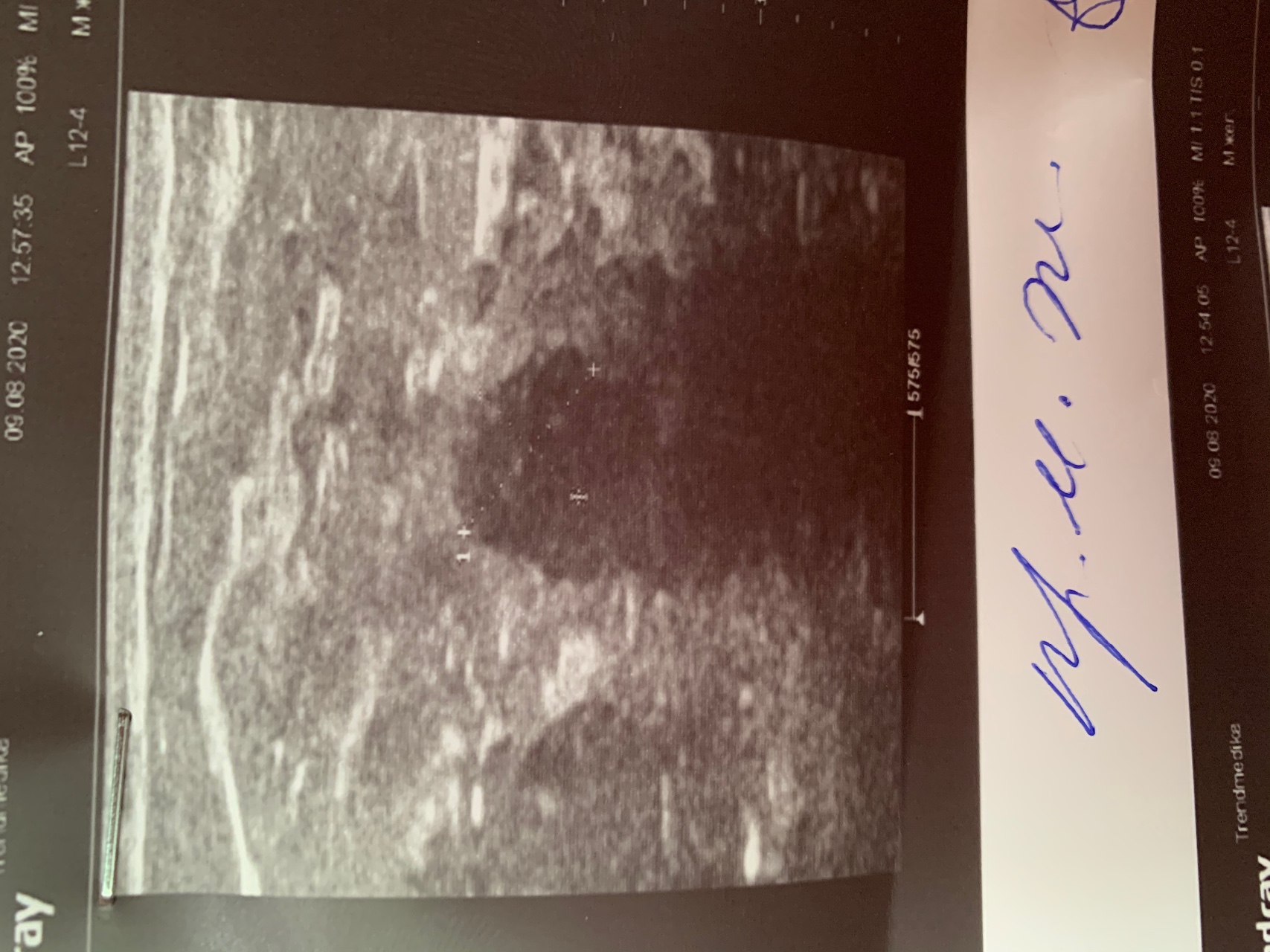 фиброаденома в груди во время беременности фото 60