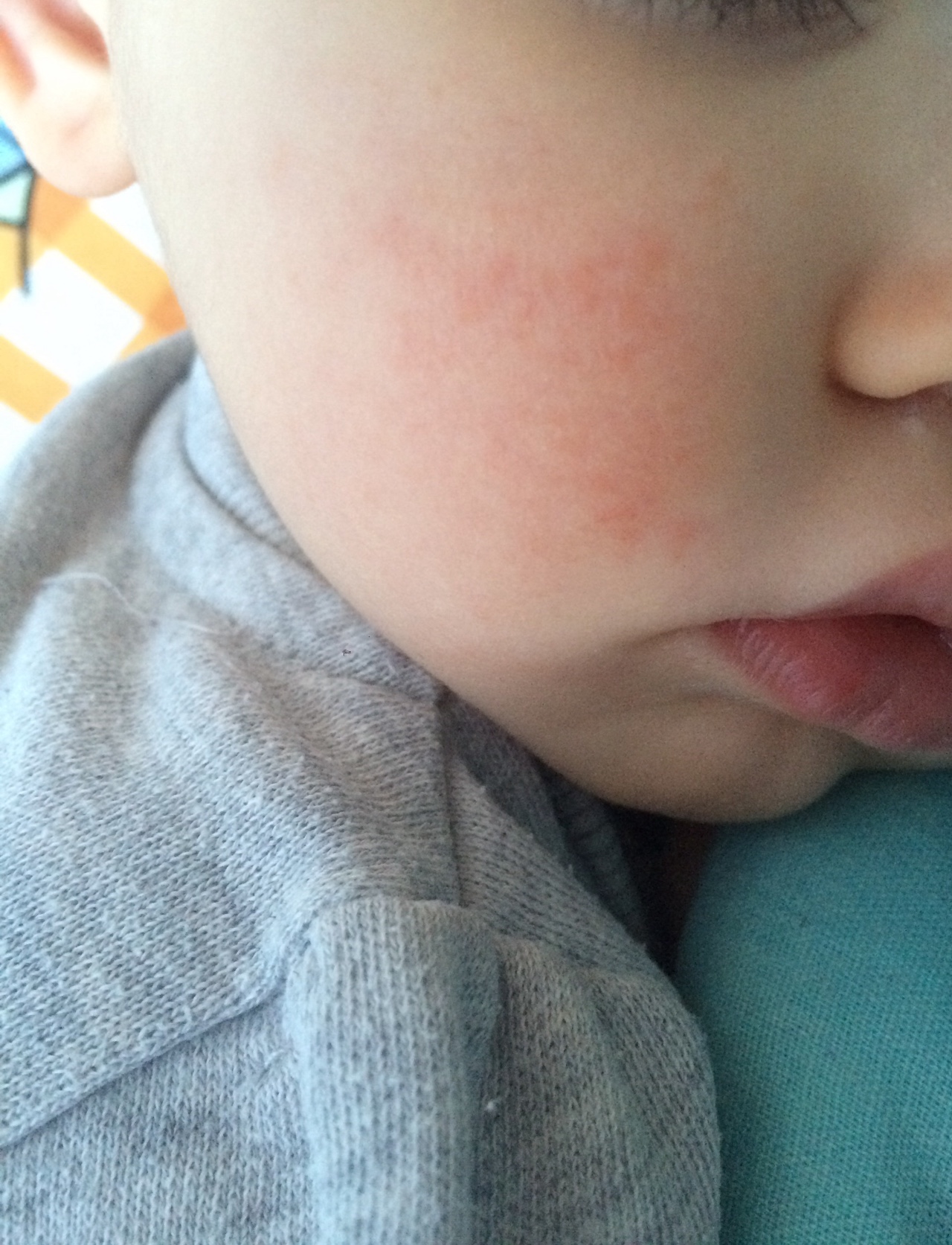 Ребенку год красные щеки. Аллергические высыпания у ребенка на щечках. Высыпания на лице у ребенка.
