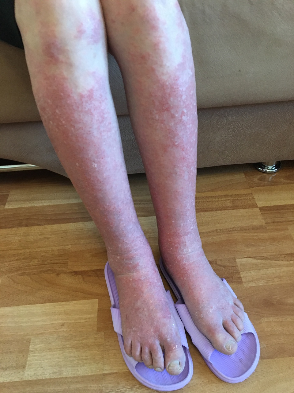 Как выглядит дерматоз на ногах фото