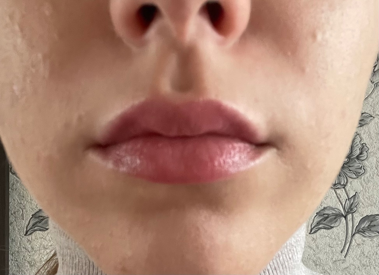 Признак различных заболеваний: белые губы
