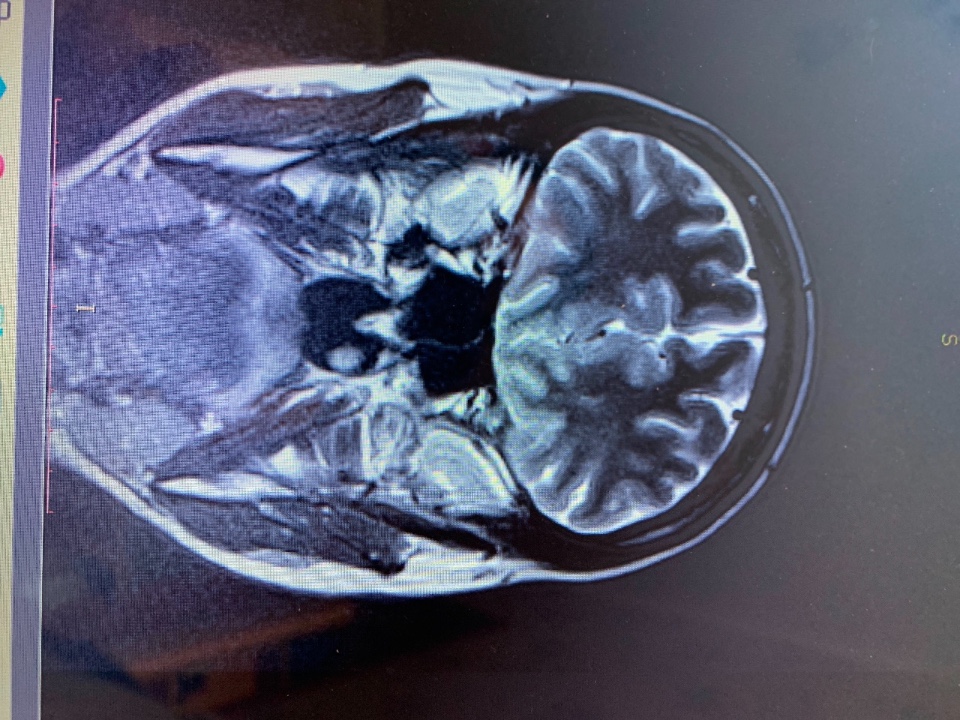 Pres головной мозг мрт. Патологии головного мозга на мрт. Мрт головного мозга изотоажение t1. Печать на мрт головного мозга для бокса.