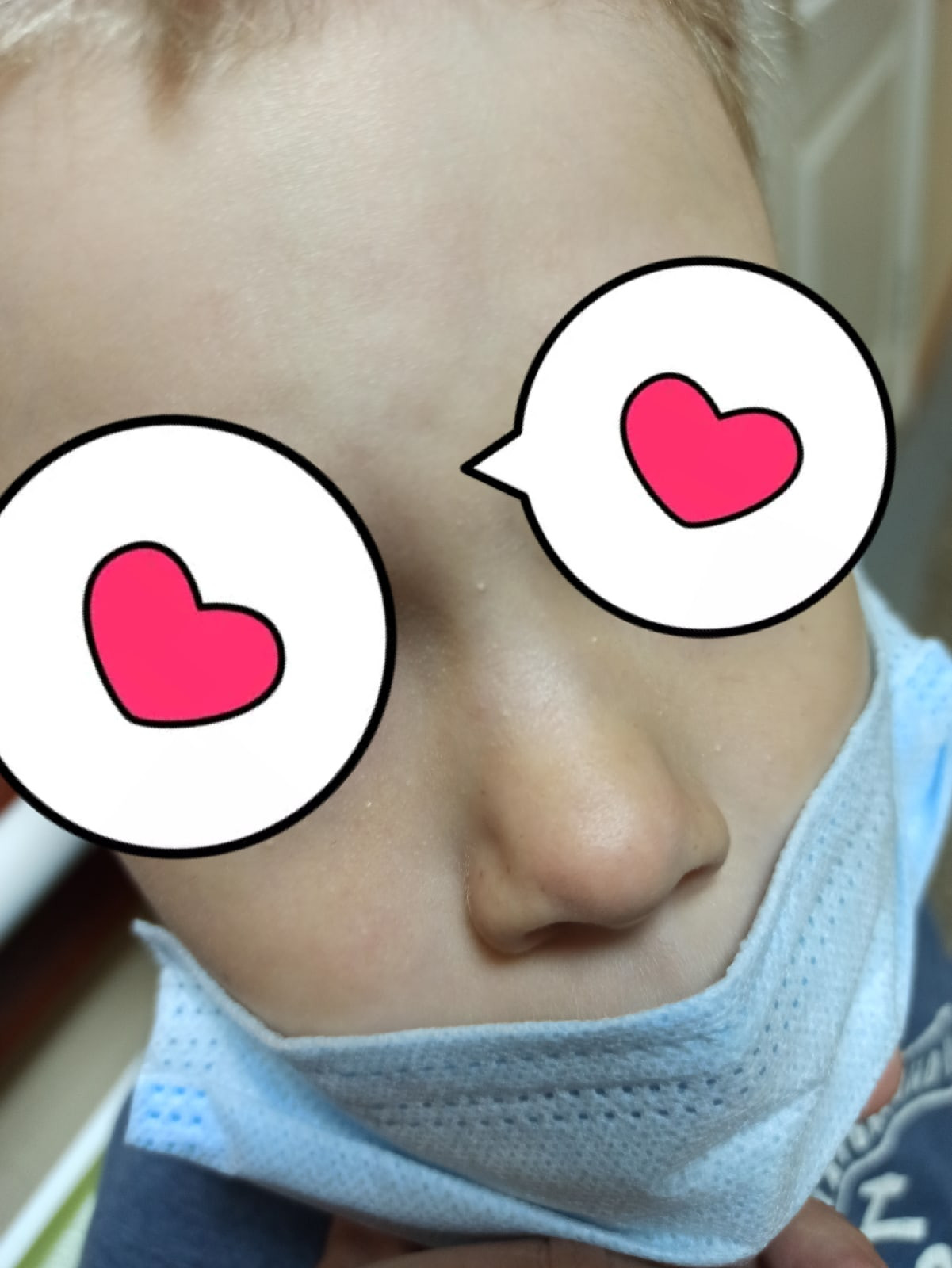 Пупырышки на лице у ребенка 5 лет