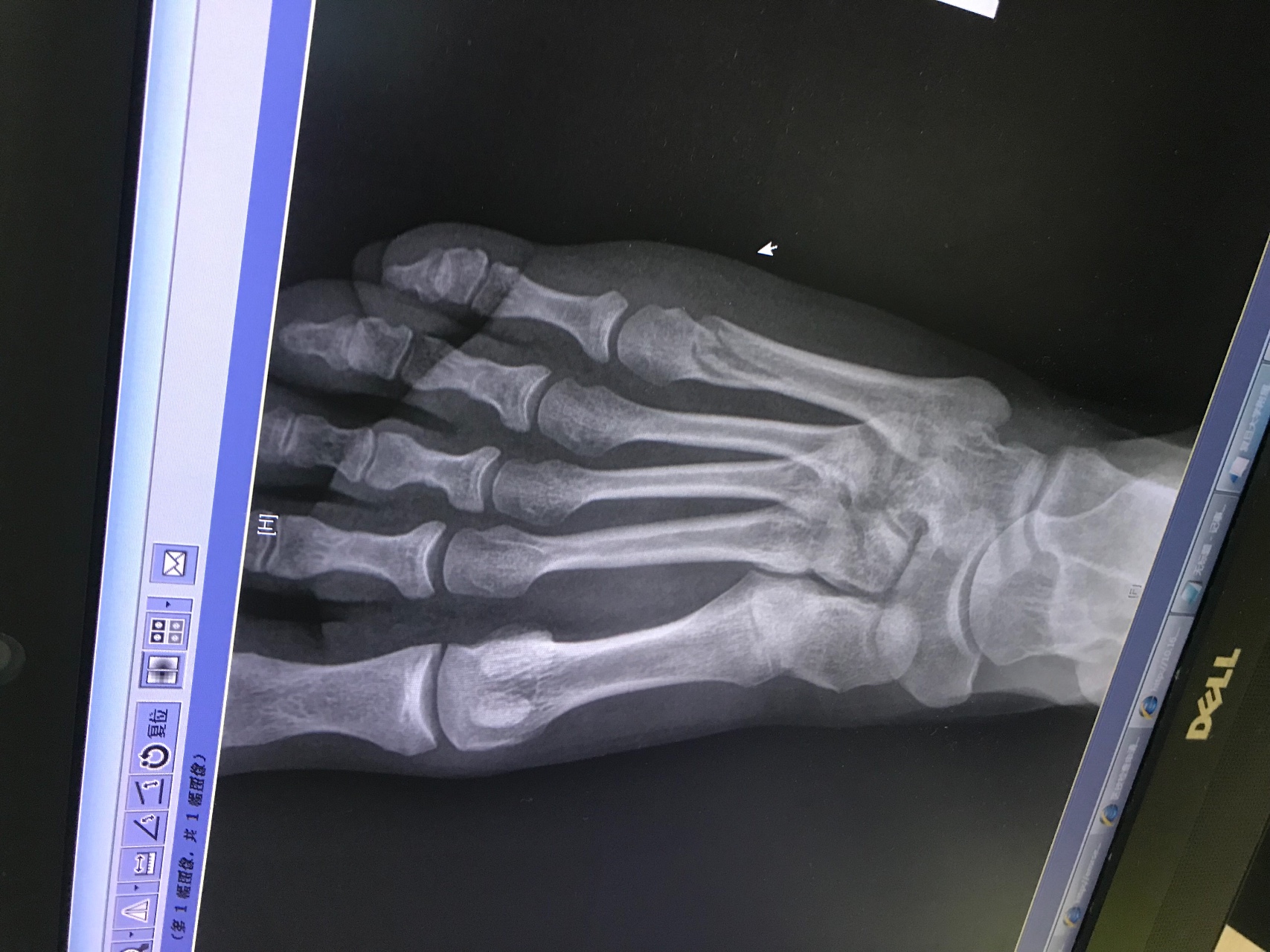 Малоберцовая кость фото на ноге перелом