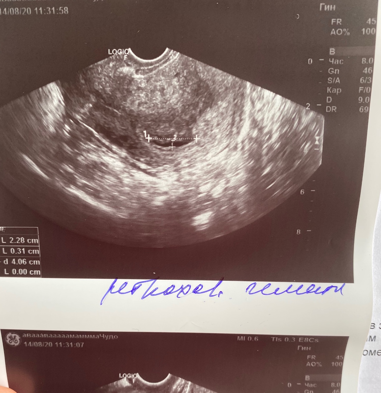 Беременность 7 недель ретрохориальная гематома