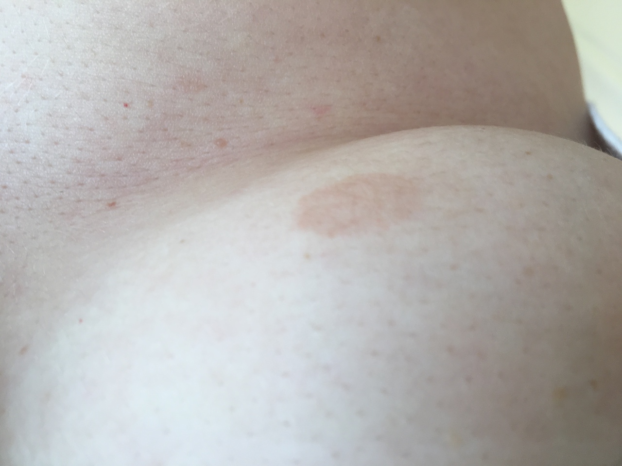 светлые пятна на груди женщин фото 41