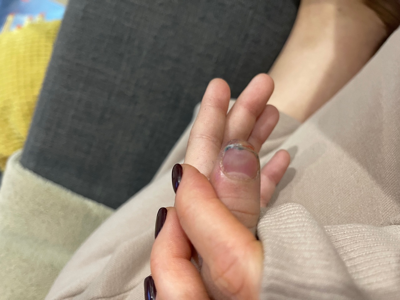 Подкожная гематома на пальце