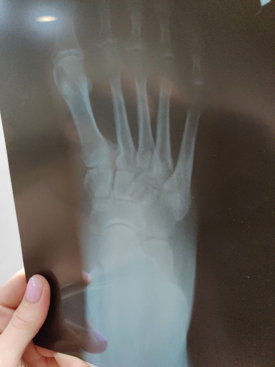 Перелом пальца на ноге рентген