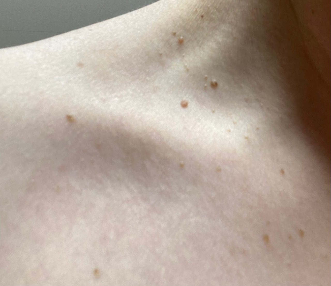 папилломы на груди у женщин фото 12