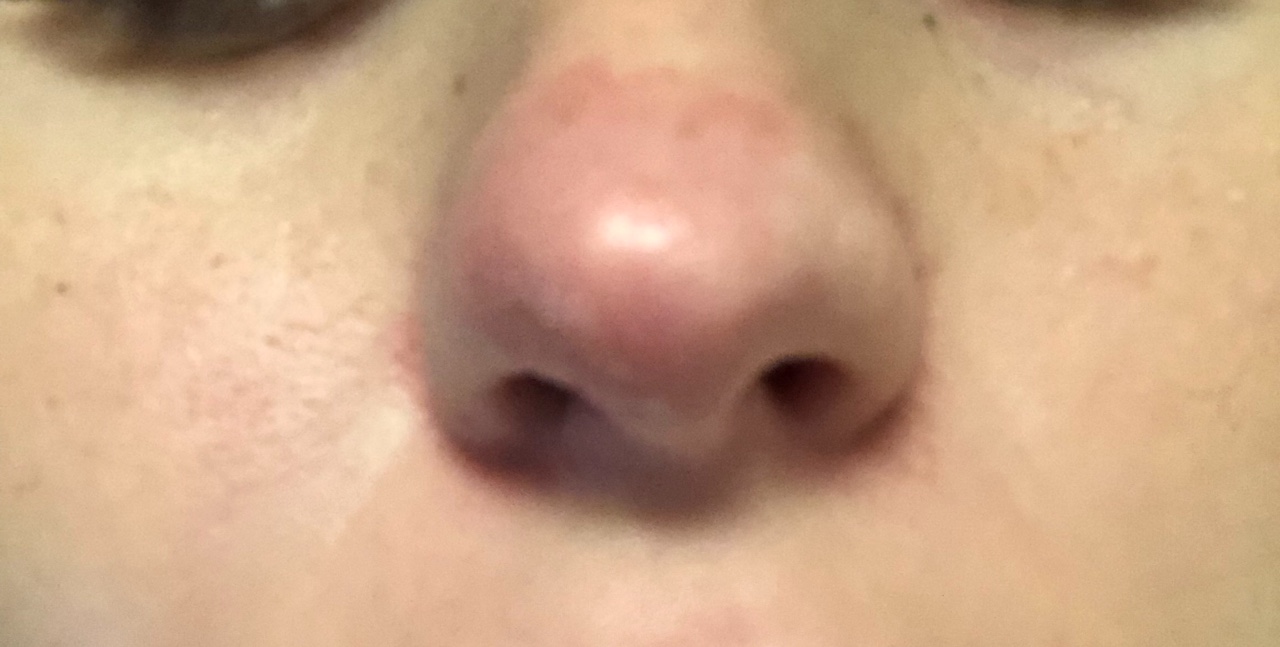 Симптомы фурункула носа