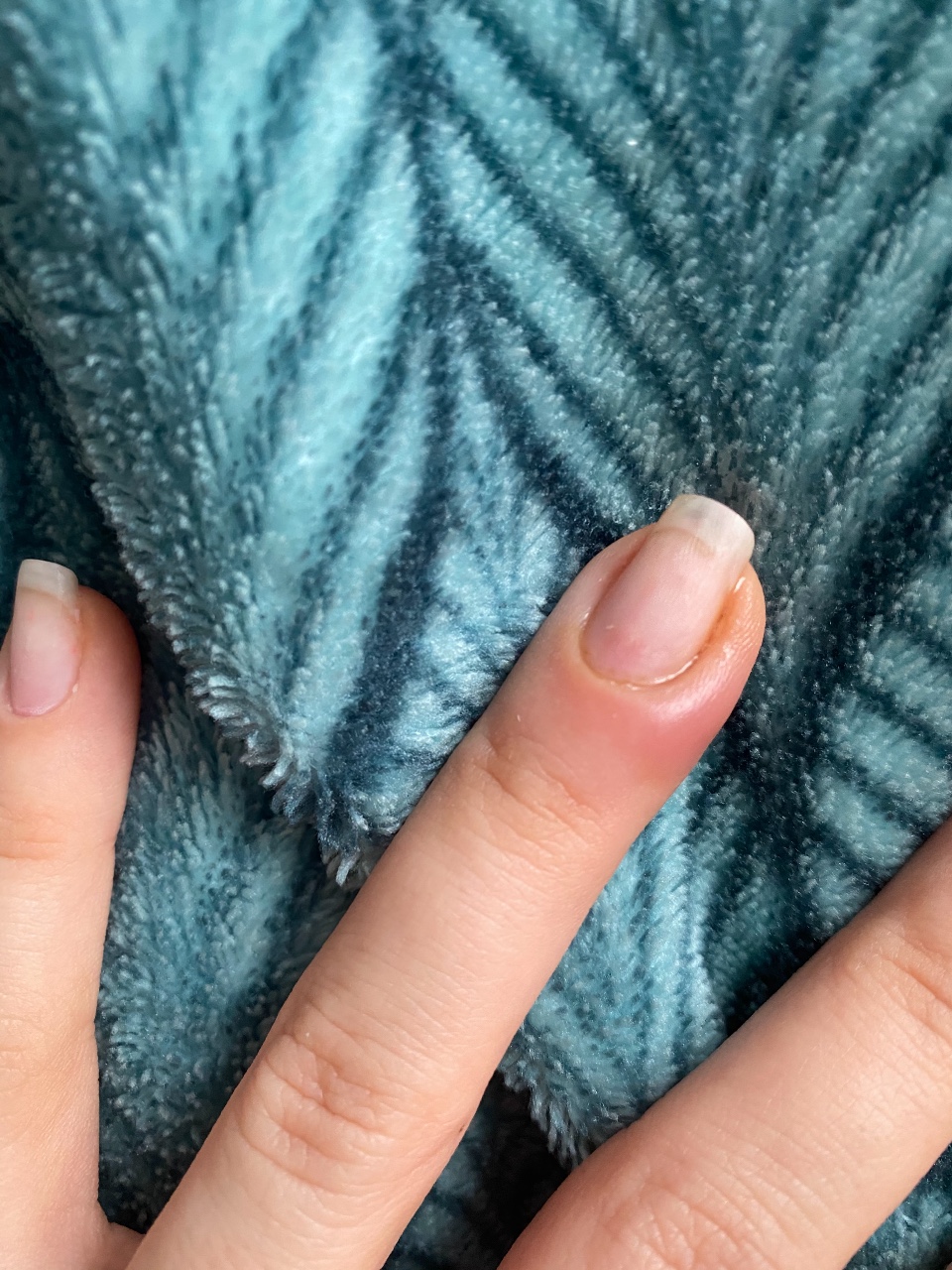 Панариций на пальце руки - Вопрос хирургу - 03 Онлайн