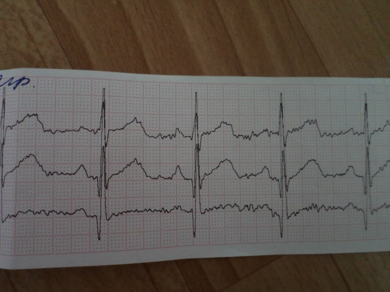 Плохая кардиограмма сердца у взрослого фото