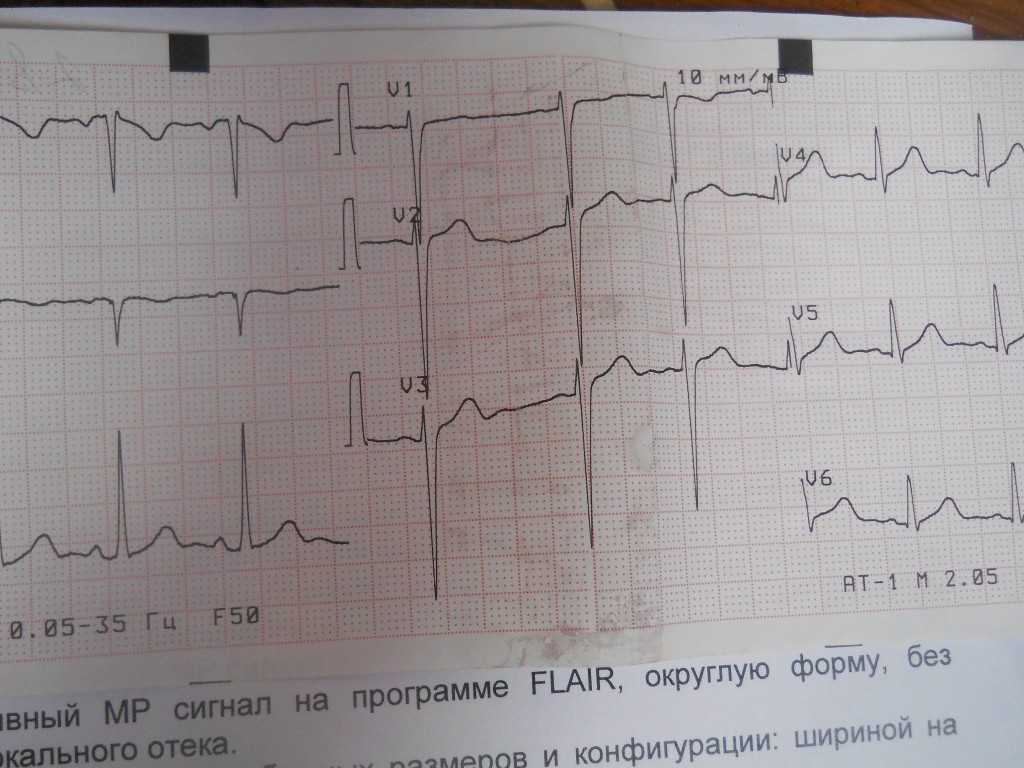 Как выглядит инфаркт на кардиограмме фото