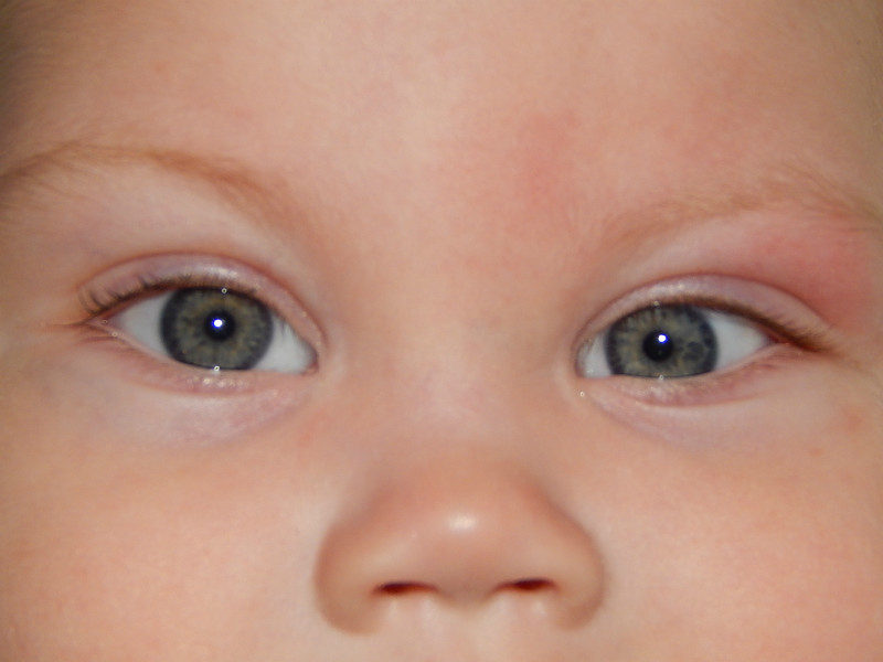 Ребенок косит глазки. Горизонтальный нистагм у новорожденных. Нистагм глаз у новорожденных. Врожденное косоглазие. Косоглазие у новорожденных.
