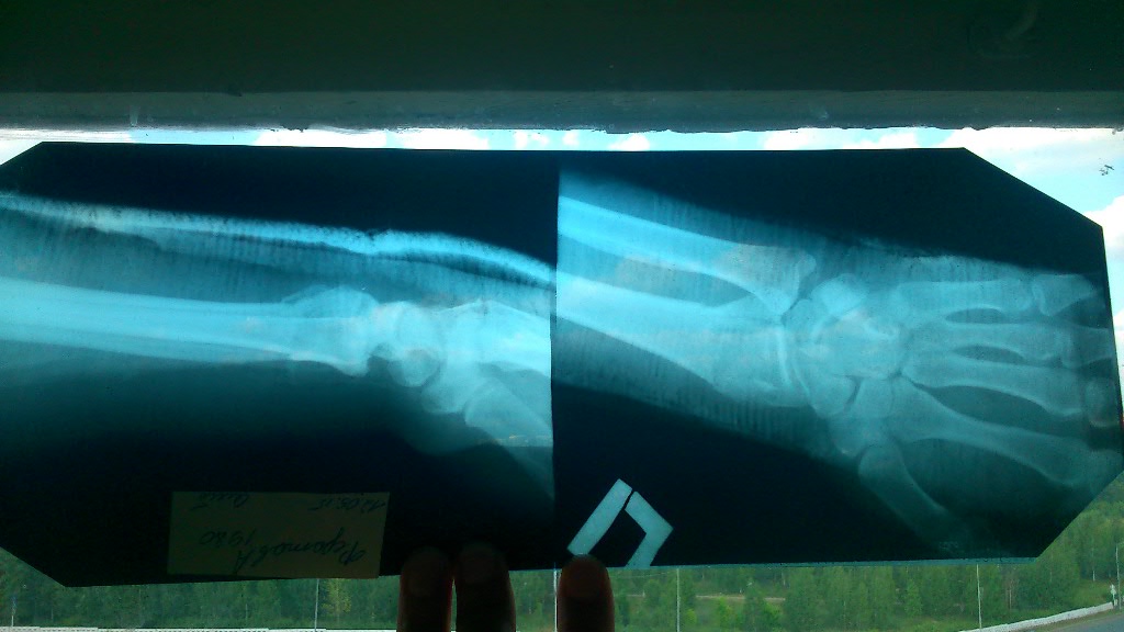 Неправильно срастается кость после перелома