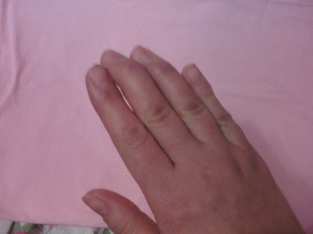 Как восстановить палец после. Деформация мизинца на руке. Палец после ушиба Кривой. Палец на руке мизинец Кривой.