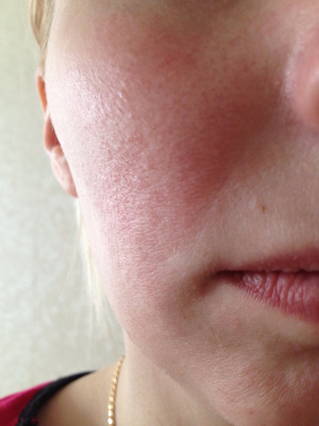 Покраснение на лице не проходит 3 года - Вопрос дерматологу - 03 Онлайн