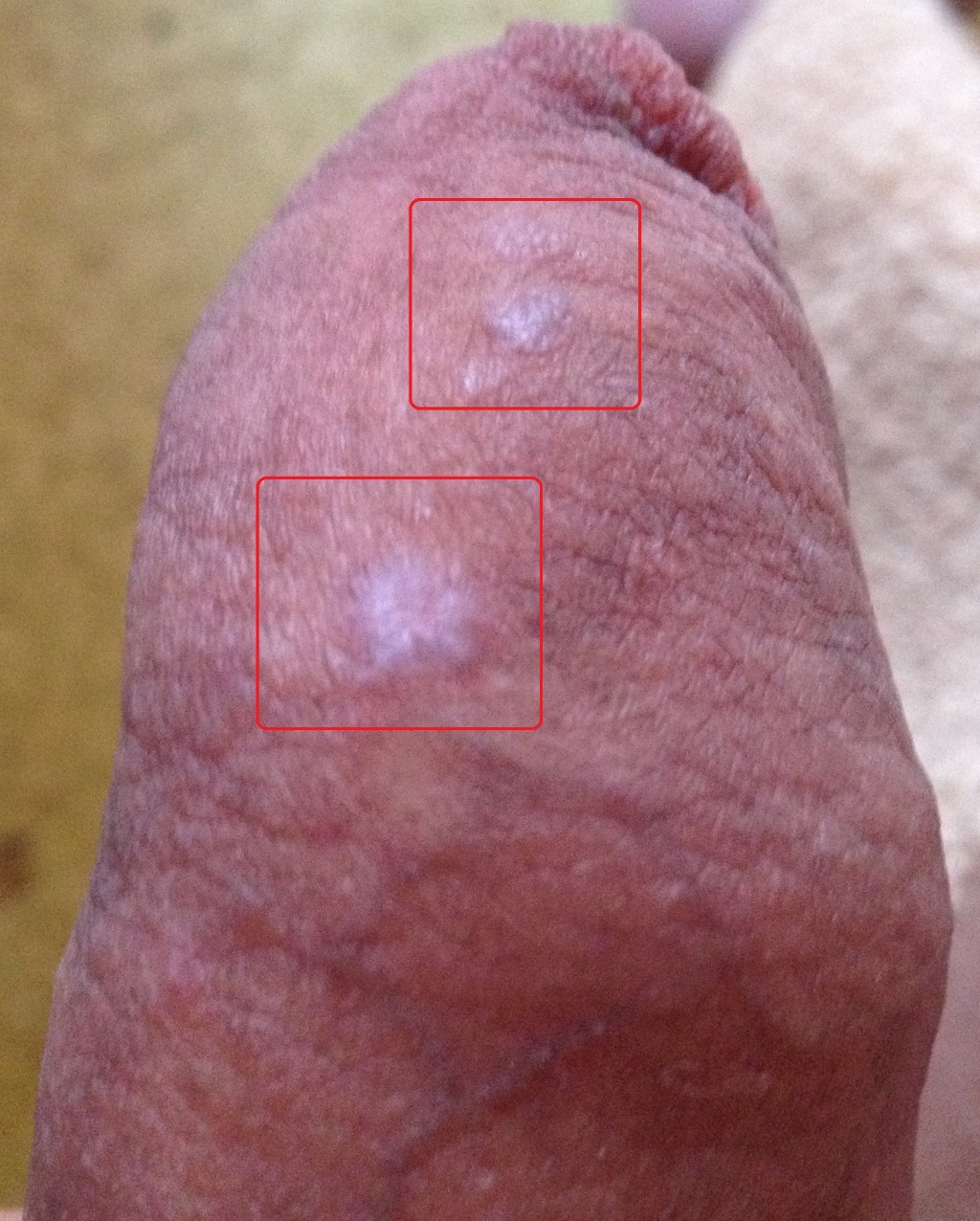 Пятно На Пенисе.