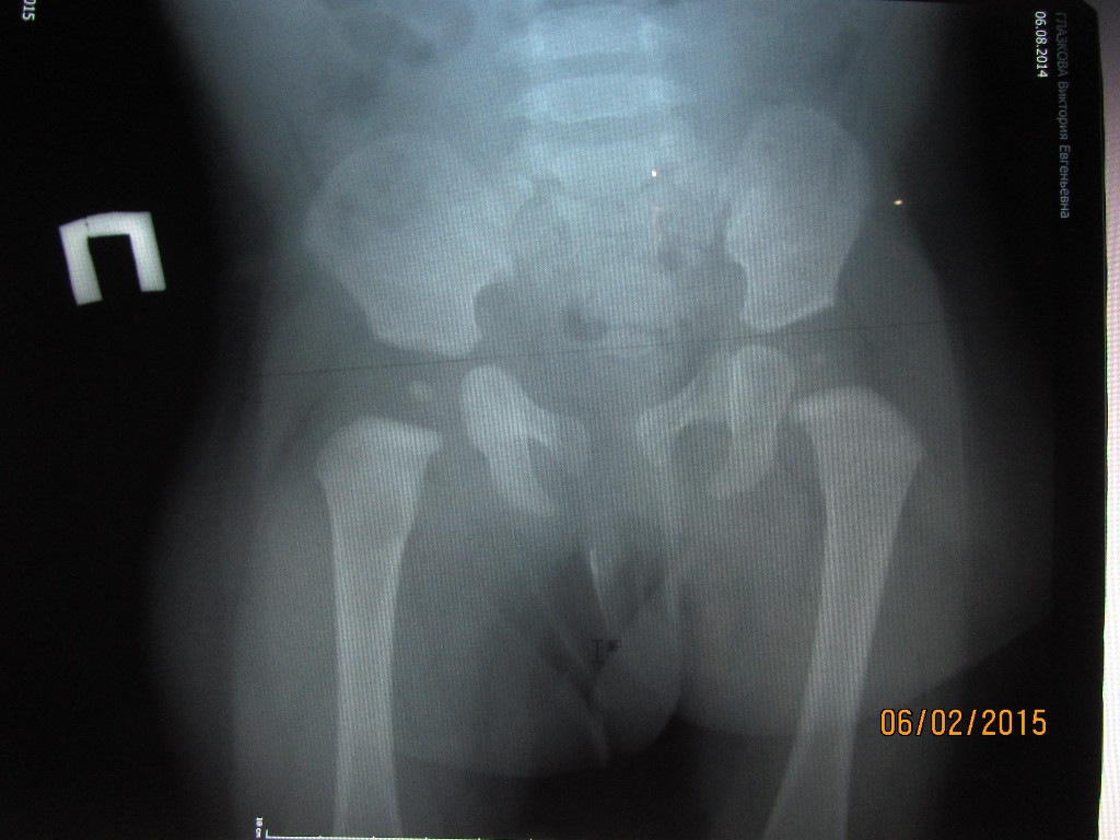 Что такое тбс. Рентген ТБС В 6 месяцев. Снимок рентгена при дисплазии ТБС. Дисплазия ТБС У ребенка рентген.
