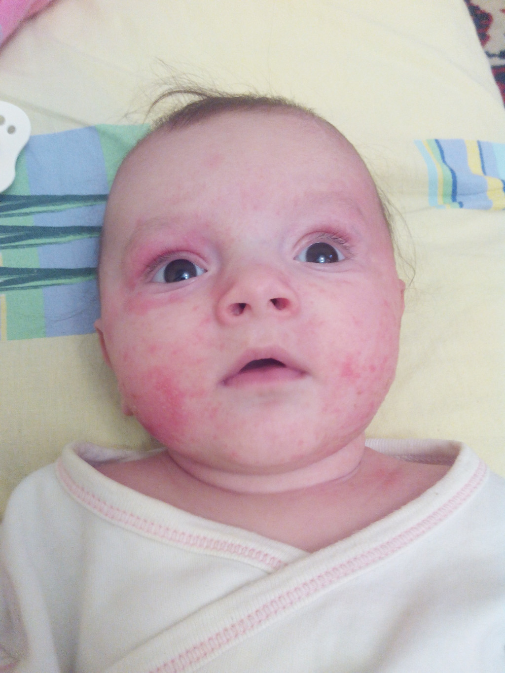 Атопический дерматит у детей фото