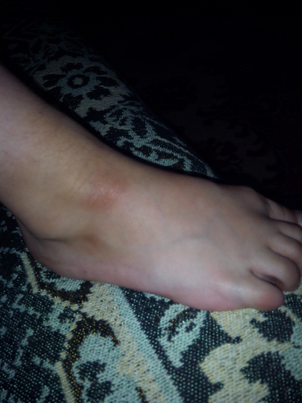 Причины появления пятен на ногах при варикозной болезни