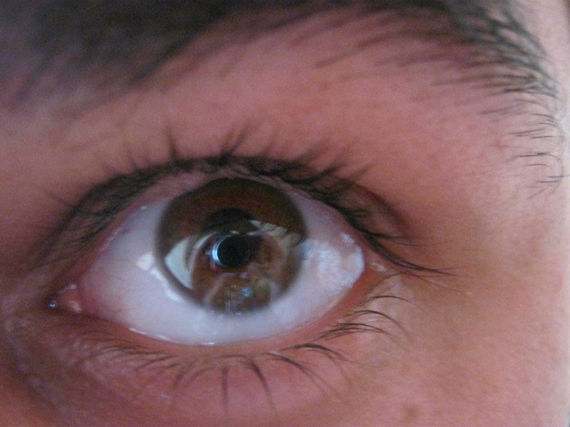 Почему возникает и как лечится герпес около глаза?