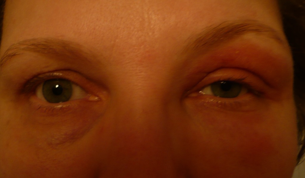 Почему чешется глаза у женщин. Герпетический дерматит век. Периорбитальный дерматит. Периорбитальный дерматит век. Атопический дерматит вокруг глаз.