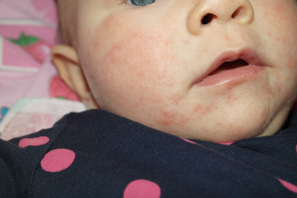 Красные пятна на лице на теле у ребенка фото с пояснениями