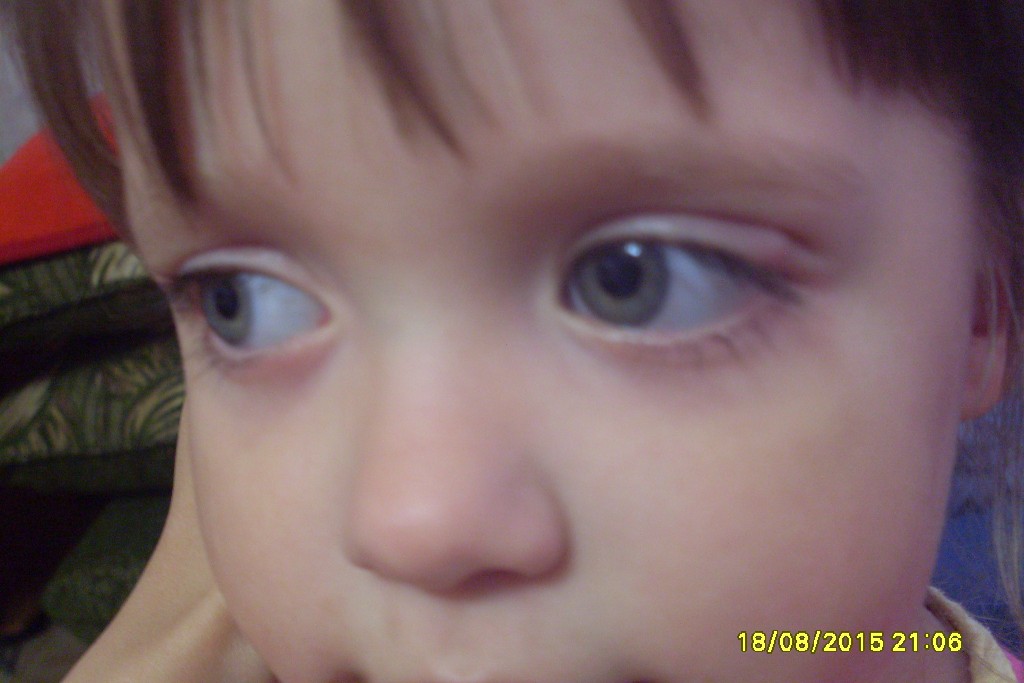 Как начинается ячмень на глазу у ребенка фото