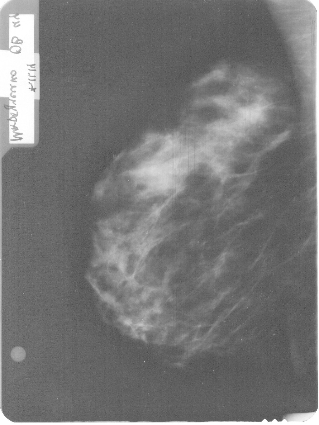 Маммография молочных желез расшифровка норма