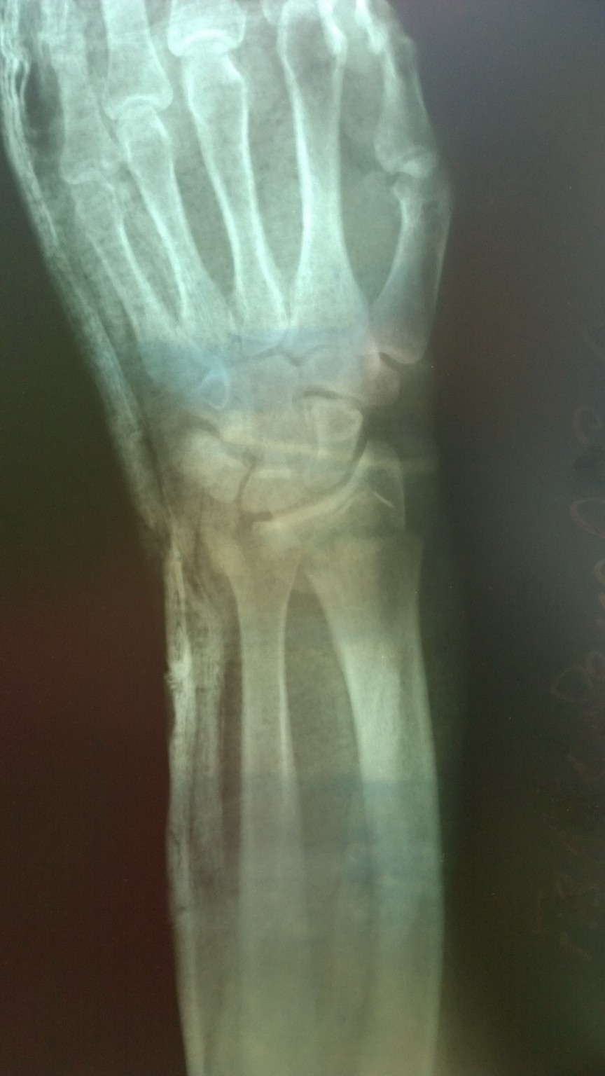 Перелом нижнего конца лучевой кости фото