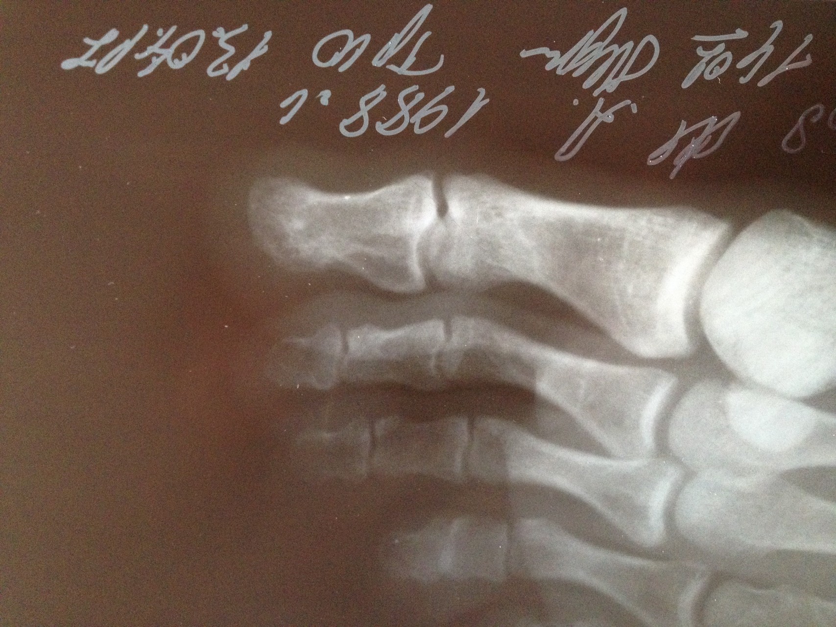 Ногтевая фаланга ноги. Краевой перелом основной фаланги 1 пальца. Внутрисуставной перелом ногтевой фаланги 1 пальца стопы. Перелом фаланги пальца стопы рентген. Перелом ногтевой фаланги большого пальца руки.