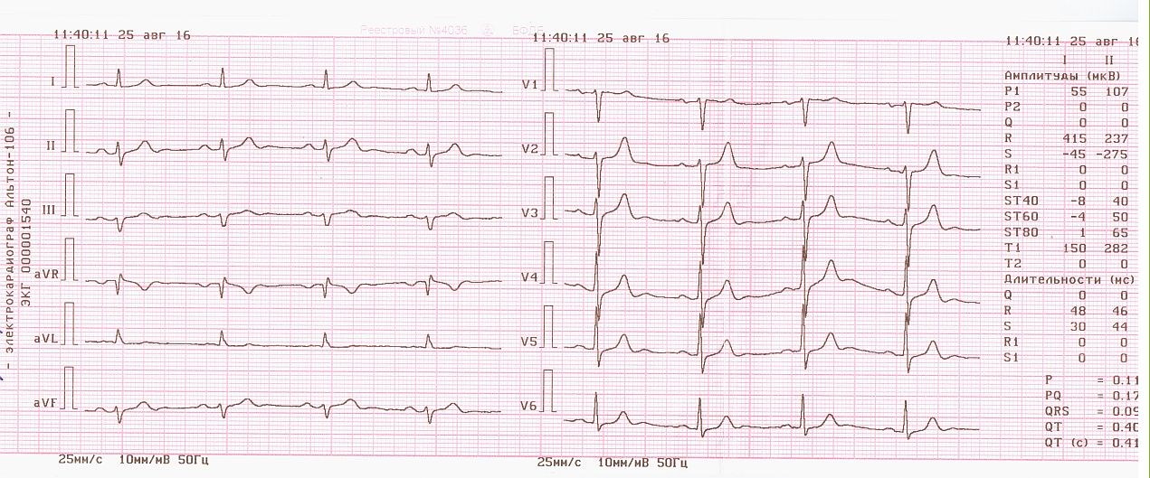 Как выглядит экг. ЭКГ норма в 12 отведениях. Кардиограмма сердца расшифровка норма. Нормальная ЭКГ 50 мм/с. ЭКГ норма расшифровка кардиограммы.
