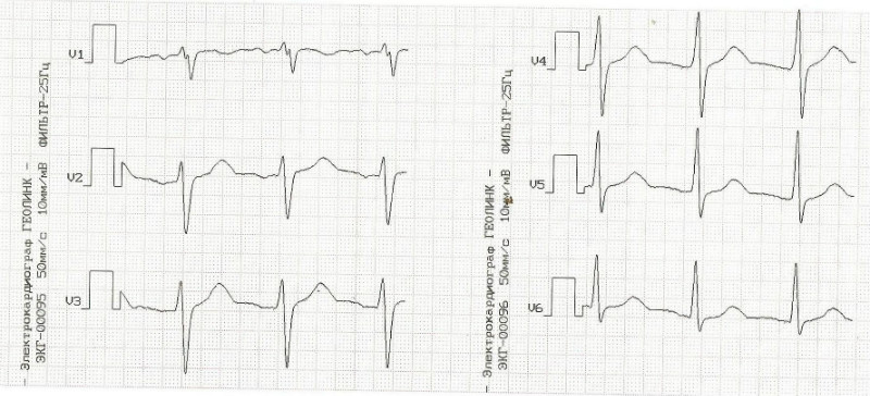 Хм экг расшифровка. Дыхательная аритмия на ЭКГ. ЭКГ В 14 лет у мальчиков в норме. Мальчик 13 лет на ЭКГ.