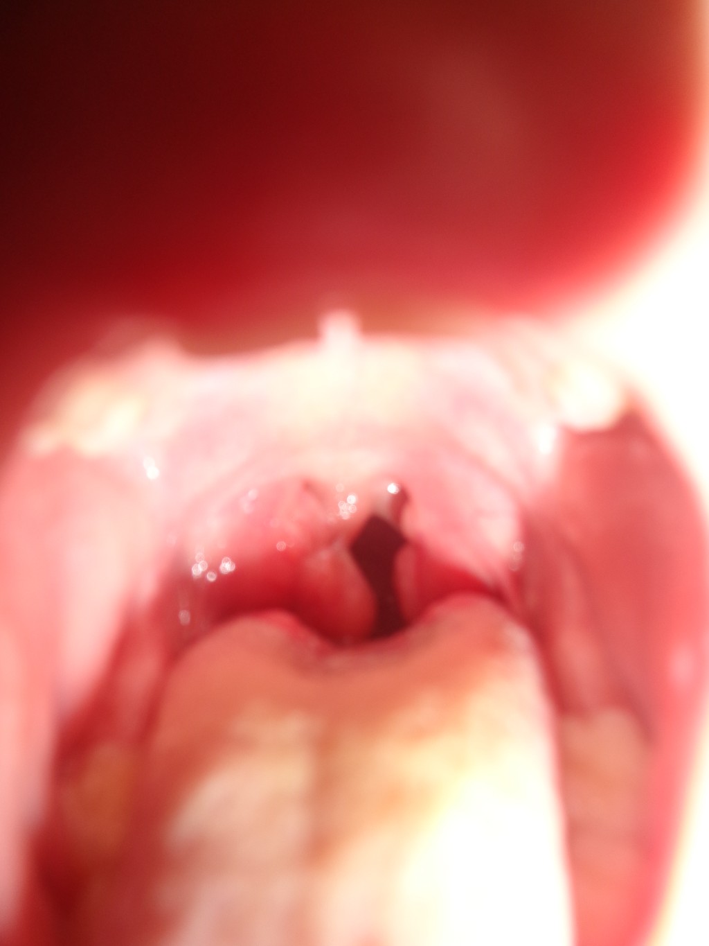 Лечение гланд - Вопрос лору - 03 Онлайн