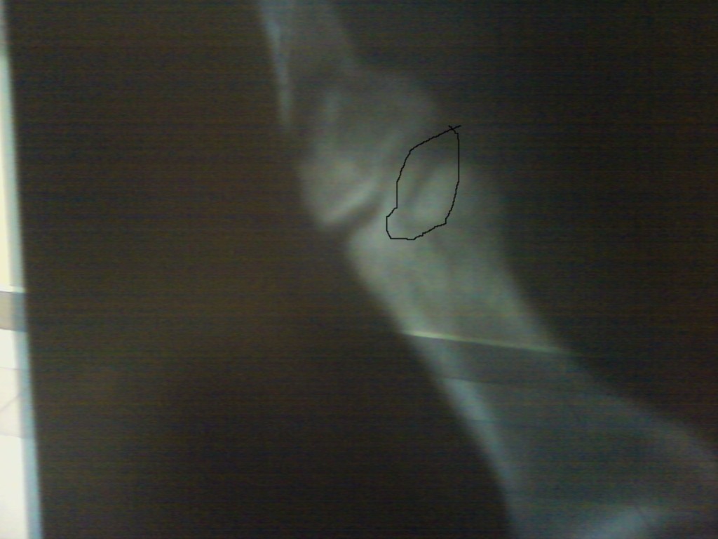 Трещина задней стенки. Перелом ногтевой фаланги рентген. Краевой перелом ногтевой фаланги рентген.