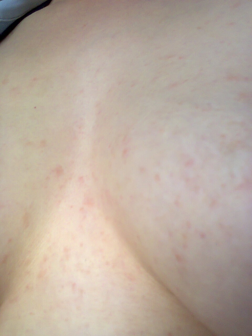 сыпь на грудях у мужчин фото 5