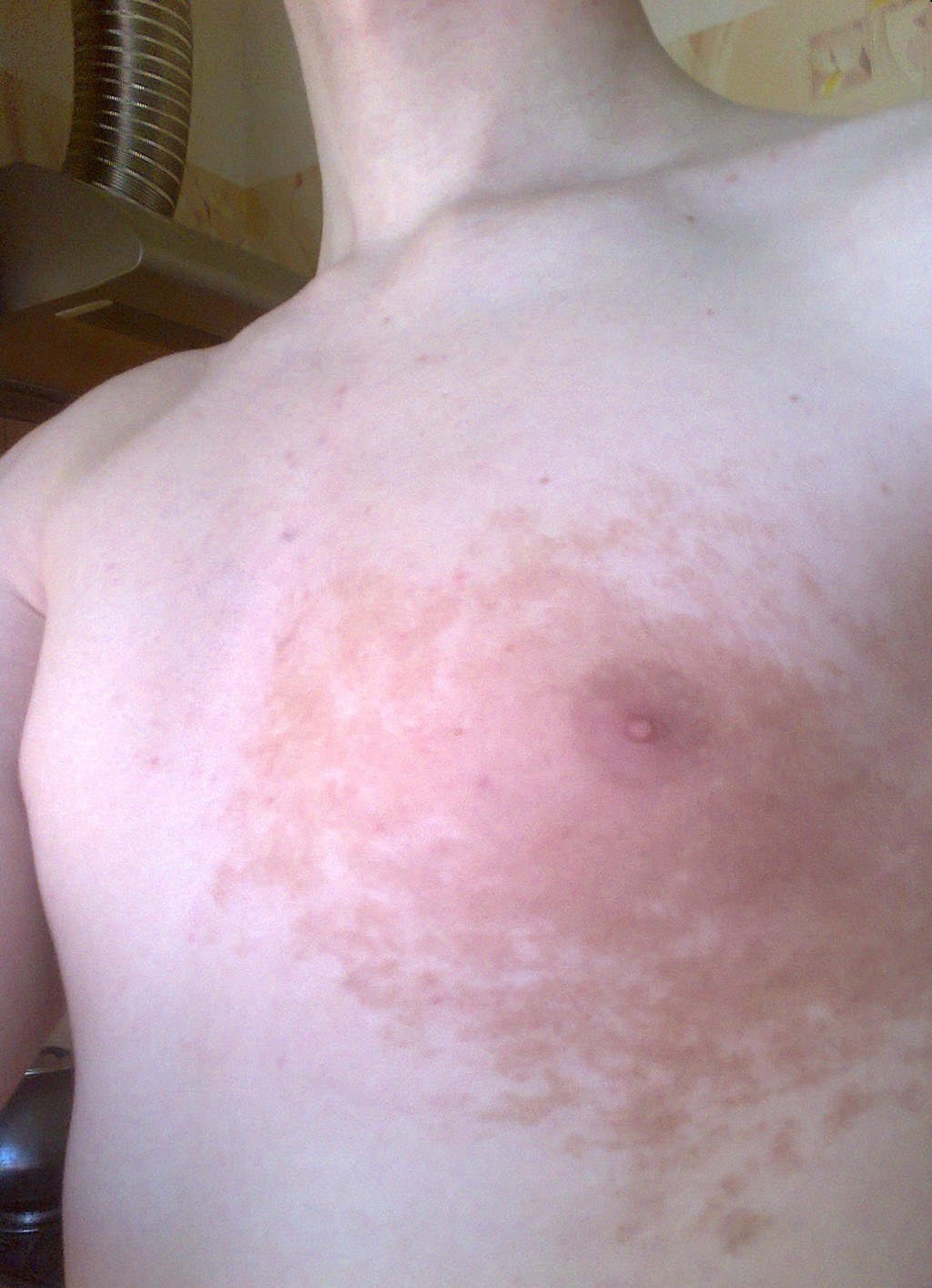 раздражение кожи у мужчин на груди фото 77