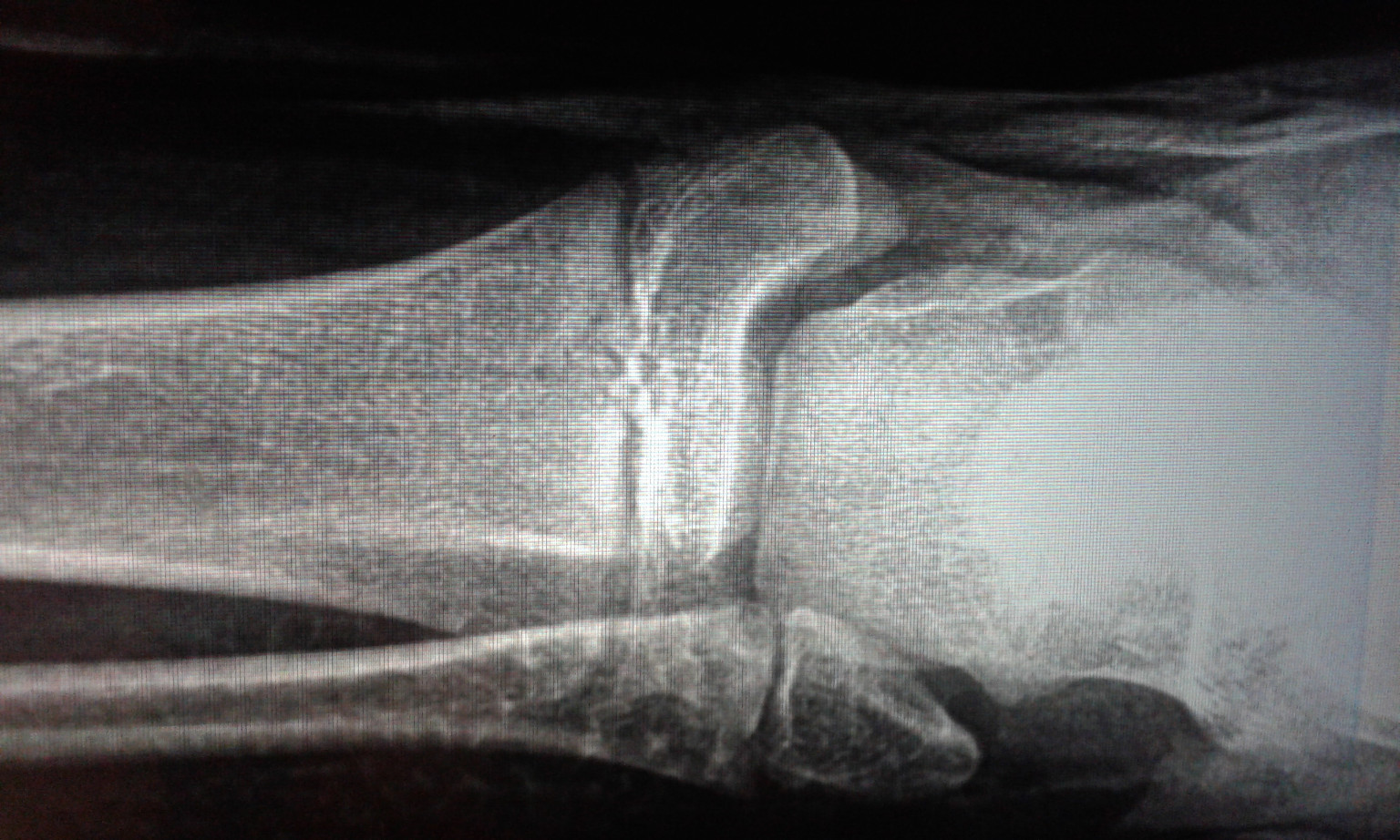 Перелом малой берцовой кости рентген