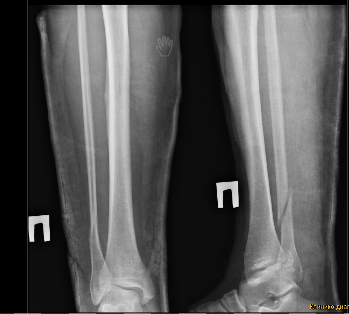 Сломал руку обезболивающее. Нога после снятия гипса. Перелом латеральной лодыжки гипс. Снимок после снятия гипса. Перелом после снятия гипса.