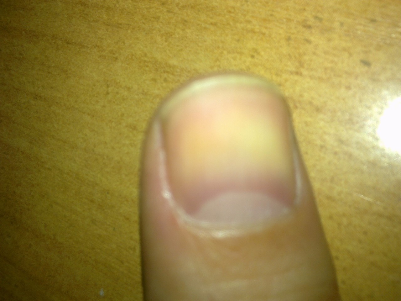 Почему ногти синеют причина. Лейконихия продольная. Белое пятно на ногте большого пальца. Белое пятнышко на ногте большого пальца. Белые пятна на ногтях больших пальцев.