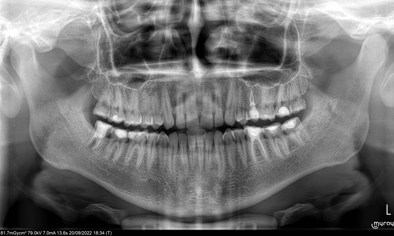 Расшифровка снимка. Снимки зубов многокорневых.