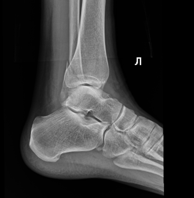 Перелом лодыжки мкб 10. Перелом наружной лодыжки гипс. Перелом лодыжки без смещения гипс. Перелом латеральной лодыжки без смещения.