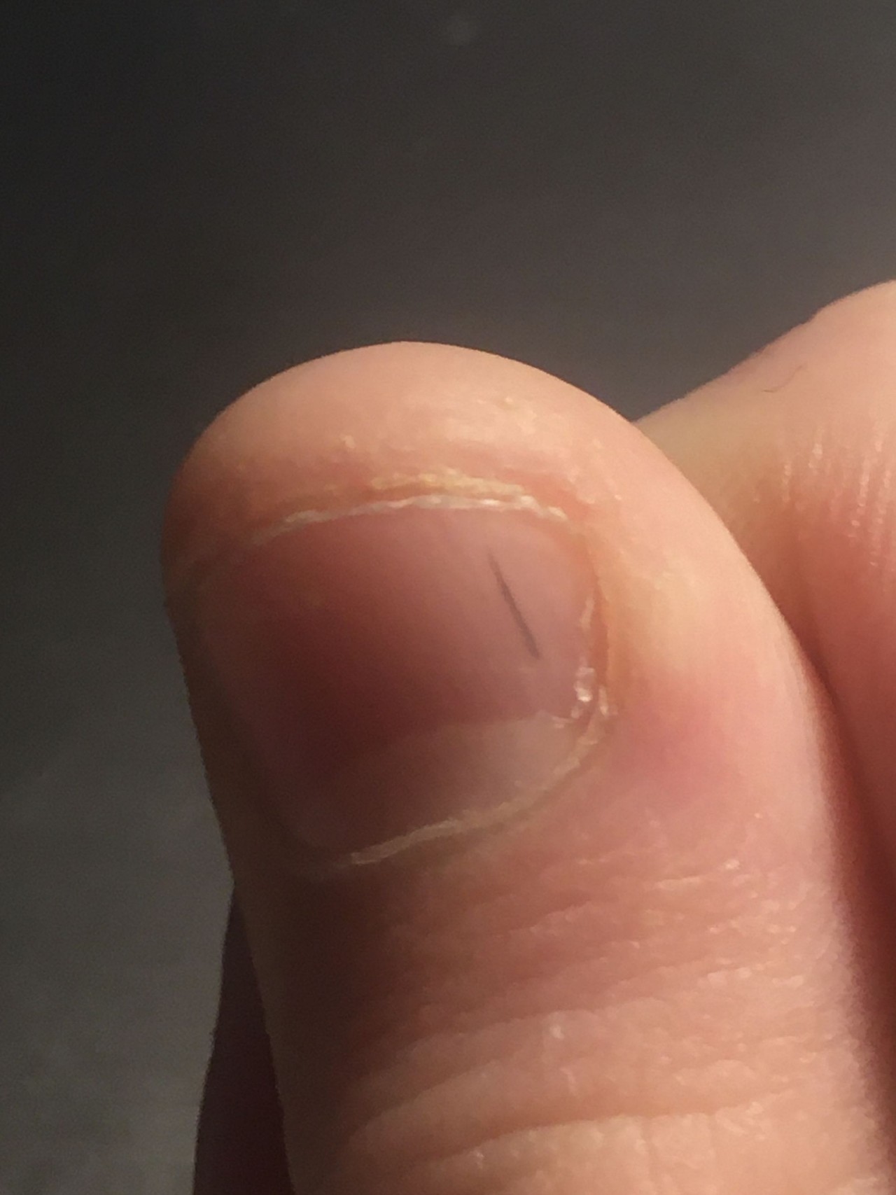 Продольные полосы на ногтях о чем говорят. Продольные полосы на ногтях. Маленькие коричневые полоски на ногтях. Красные полоски под ногтями.